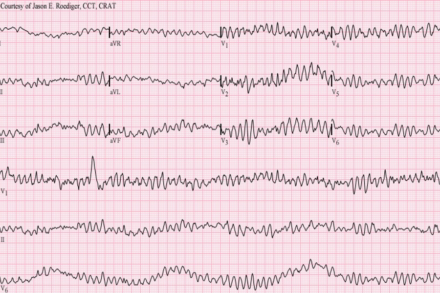 Arrhythmogenic